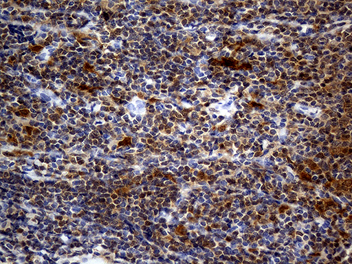 Immunohistochemical staining of paraffin-embedded Human lymphoma tissue using anti-DAPP1 mouse monoclonal antibody