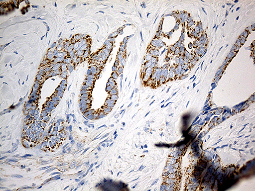 Immunohistochemical staining of paraffin-embedded Adenocarcinoma of Human ovary tissue using anti-MTX2 mouse monoclonal antibody