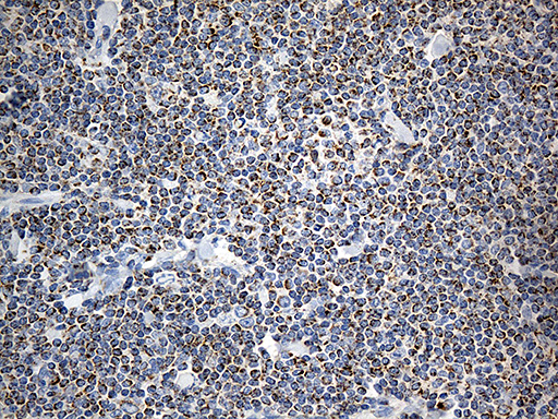 Immunohistochemical staining of paraffin-embedded Human lymphoma tissue using anti-MTX2 mouse monoclonal antibody