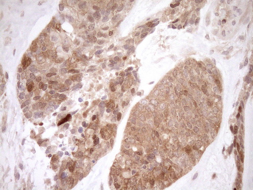 Immunohistochemical staining of paraffin-embedded Adenocarcinoma of Human endometrium tissue using anti-ITPK1 mouse monoclonal antibody