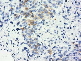 Immunohistochemical staining of paraffin-embedded Adenocarcinoma of Human ovary tissue using anti-LIN7B mouse monoclonal antibody