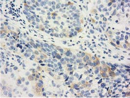 Immunohistochemical staining of paraffin-embedded Carcinoma of Human bladder tissue using anti-LIN7B mouse monoclonal antibody