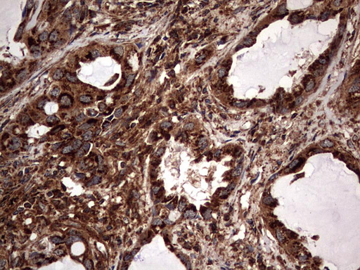 Immunohistochemical staining of paraffin-embedded Carcinoma of Human lung tissue using anti-NRBF2 mouse monoclonal antibody