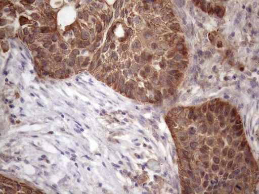 Immunohistochemical staining of paraffin-embedded Carcinoma of Human lung tissue using anti-AMTN mouse monoclonal antibody. (Heat-induced epitope retrieval by 1mM EDTA in 10mM Tris buffer (pH8.5) at 120°C for 3min