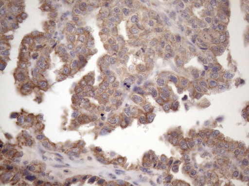 Immunohistochemical staining of paraffin-embedded Adenocarcinoma of Human ovary tissue using anti-AMTN mouse monoclonal antibody. (Heat-induced epitope retrieval by 1mM EDTA in 10mM Tris buffer (pH8.5) at 120°C for 3min
