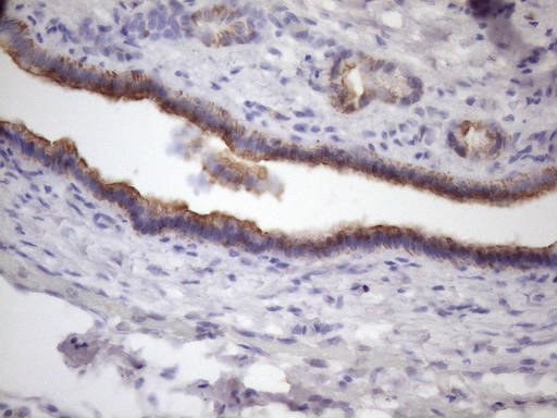 Immunohistochemical staining of paraffin-embedded Carcinoma of Human pancreas tissue using anti-AMTN mouse monoclonal antibody. (Heat-induced epitope retrieval by 1mM EDTA in 10mM Tris buffer (pH8.5) at 120°C for 3min