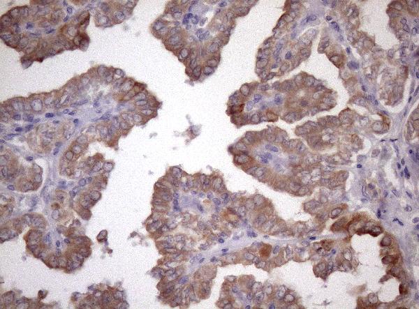 Immunohistochemical staining of paraffin-embedded Carcinoma of Human thyroid tissue using anti-AMTN mouse monoclonal antibody. (Heat-induced epitope retrieval by 1mM EDTA in 10mM Tris buffer (pH8.5) at 120°C for 3min