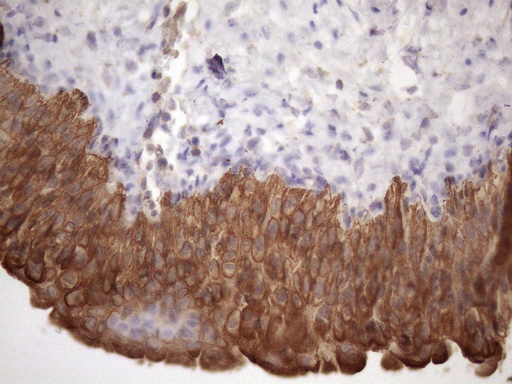 Immunohistochemical staining of paraffin-embedded Carcinoma of Human prostate tissue using anti-AMTN mouse monoclonal antibody. (Heat-induced epitope retrieval by 1mM EDTA in 10mM Tris buffer (pH8.5) at 120°C for 3min