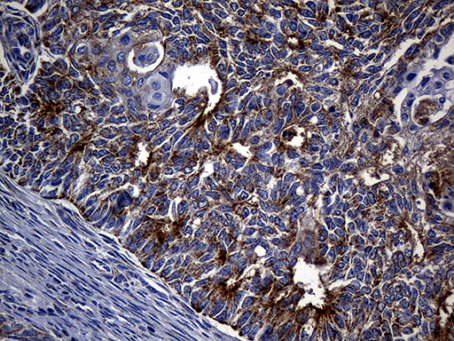 Immunohistochemical staining of paraffin-embedded Adenocarcinoma of Human endometrium tissue using anti-TIMM23 mouse monoclonal antibody