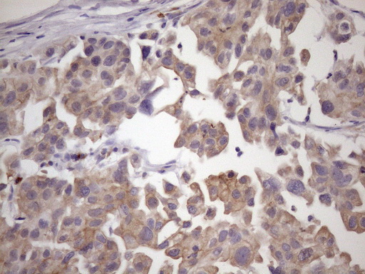 Immunohistochemical staining of paraffin-embedded Carcinoma of Human bladder tissue using anti-SMCP mouse monoclonal antibody. (Heat-induced epitope retrieval by 1mM EDTA in 10mM Tris buffer (pH8.5) at 120°C for 3min