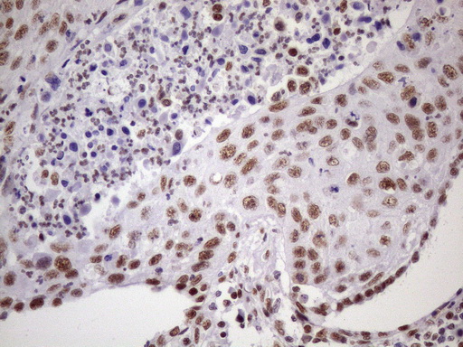 Immunohistochemical staining of paraffin-embedded Carcinoma of Human lung tissue using anti-NUDT21 mouse monoclonal antibody