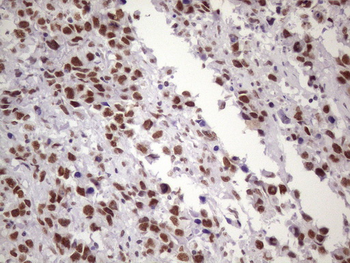 Immunohistochemical staining of paraffin-embedded Adenocarcinoma of Human ovary tissue using anti-NUDT21 mouse monoclonal antibody