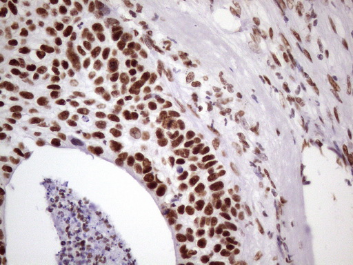 Immunohistochemical staining of paraffin-embedded Carcinoma of Human lung tissue using anti-NUDT21 mouse monoclonal antibody