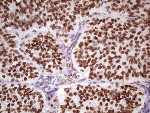 Immunohistochemical staining of paraffin-embedded Adenocarcinoma of Human ovary tissue using anti-NUDT21 mouse monoclonal antibody