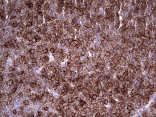 Immunohistochemical staining of paraffin-embedded Human lymphoma tissue using anti-ANGPTL1 mouse monoclonal antibody