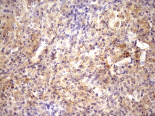 Immunohistochemical staining of paraffin-embedded Carcinoma of Human bladder tissue using anti-RAB11FIP4 mouse monoclonal antibody