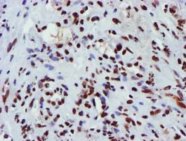 Immunohistochemical staining of paraffin-embedded Carcinoma of Human lung tissue using anti-GSTT2 mouse monoclonal antibody