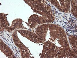 Immunohistochemical staining of paraffin-embedded Adenocarcinoma of Human ovary tissue using anti-NDOR1 mouse monoclonal antibody