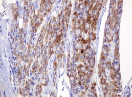 Immunohistochemical staining of paraffin-embedded Carcinoma of Human thyroid tissue using anti-AMY2B mouse monoclonal antibody