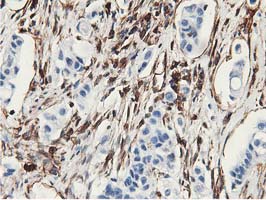 Immunohistochemical staining of paraffin-embedded Carcinoma of Human lung tissue using anti-LXN mouse monoclonal antibody