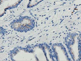 Immunohistochemical staining of paraffin-embedded Carcinoma of Human prostate tissue using anti-MOBKL1A mouse monoclonal antibody (M09405) at 1:150 dilution