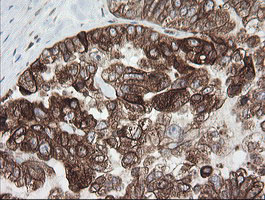 Immunohistochemical staining of paraffin-embedded Adenocarcinoma of Human ovary tissue using anti-TAPBPL mouse monoclonal antibody