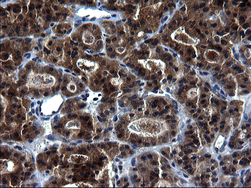 Immunohistochemical staining of paraffin-embedded Carcinoma of Human thyroid tissue using anti-HSCB mouse monoclonal antibody
