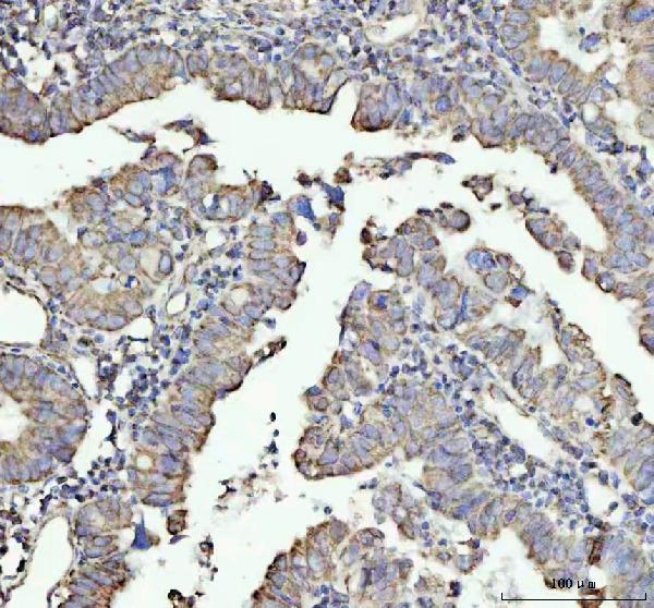 Figure 2. IHC analysis of NDUFAB1 using anti-NDUFAB1 antibody (MM09620). NDUFAB1 was detected in a paraffin-embedded section of human colorectal adenocarcinoma tissue. Heat mediated antigen retrieval was performed in EDTA buffer (pH 8.0, epitope retrieval solution). The tissue section was blocked with 10% goat serum. The tissue section was then incubated with 1:50 rabbit anti-NDUFAB1 Antibody (M09620) overnight at 4°C. Peroxidase Conjugated Goat Anti-rabbit IgG was used as secondary antibody and incubated for 30 minutes at 37°C. The tissue section was developed using HRP Conjugated Rabbit IgG Super Vision Assay Kit (Catalog # SV0002) with DAB as the chromogen. Figure 2. IHC analysis of NDUFAB1 using anti-NDUFAB1 antibody (MM09620). NDUFAB1 was detected in a paraffin-embedded section of human colorectal adenocarcinoma tissue. Heat mediated antigen retrieval was performed in EDTA buffer (pH 8.0, epitope retrieval solution). The tissue section was blocked with 10% goat serum. The tissue section was then incubated with 1:50 rabbit anti-NDUFAB1 Antibody (M09620) overnight at 4°C. Peroxidase Conjugated Goat Anti-rabbit IgG was used as secondary antibody and incubated for 30 minutes at 37°C. The tissue section was developed using HRP Conjugated Rabbit IgG Super Vision Assay Kit (Catalog # SV0002) with DAB as the chromogen.