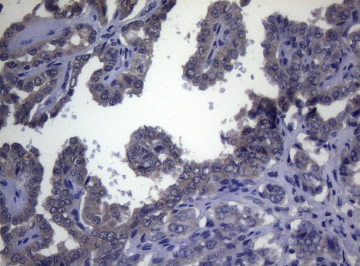 Immunohistochemical staining of paraffin-embedded Carcinoma of Human thyroid tissue using anti-FOXQ1 mouse monoclonal antibody