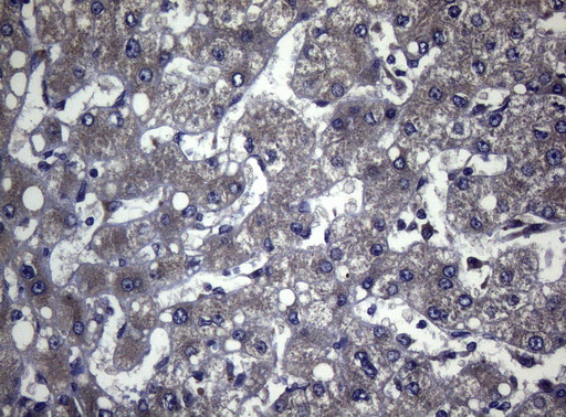 Immunohistochemical staining of paraffin-embedded Carcinoma of Human liver tissue using anti-FOXQ1 mouse monoclonal antibody