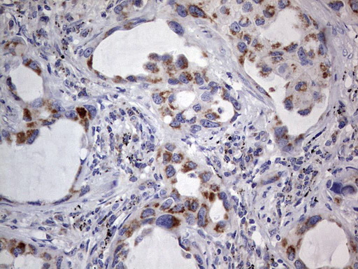 Immunohistochemical staining of paraffin-embedded Carcinoma of Human lung tissue using anti-IGSF11 mouse monoclonal antibody