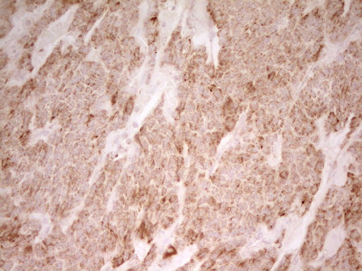 Immunohistochemical staining of paraffin-embedded Carcinoma of Human lung tissue using anti-MRRF mouse monoclonal antibody