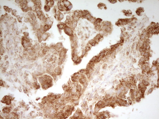 Immunohistochemical staining of paraffin-embedded Adenocarcinoma of Human ovary tissue using anti-MRRF mouse monoclonal antibody