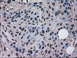 Immunohistochemical staining of paraffin-embedded Carcinoma of Human pancreas tissue using anti-MRI1 mouse monoclonal antibody