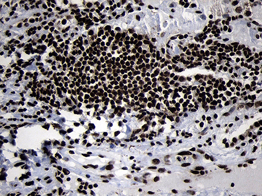 Immunohistochemical staining of paraffin-embedded Carcinoma of Human lung tissue using anti-HOXC4 mouse monoclonal antibody