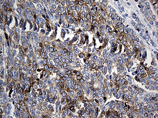 Immunohistochemical staining of paraffin-embedded Adenocarcinoma of Human breast tissue tissue using anti-CLEC10A mouse monoclonal antibody
