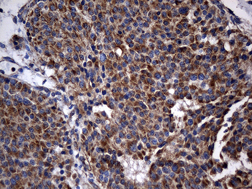 Immunohistochemical staining of paraffin-embedded Carcinoma of Human pancreas tissue using anti-STBD1 mouse monoclonal antibody