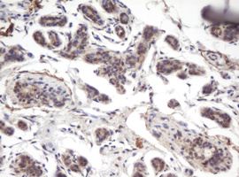 Immunohistochemical staining of paraffin-embedded Human breast tissue within the normal limits using anti-PRR11 mouse monoclonal antibody. (Heat-induced epitope retrieval by 10mM citric buffer Immunohistochemical staining of paraffin-embedded Human breast tissue within the normal limits using anti-PRR11 mouse monoclonal antibody. (Heat-induced epitope retrieval by 10mM citric buffer