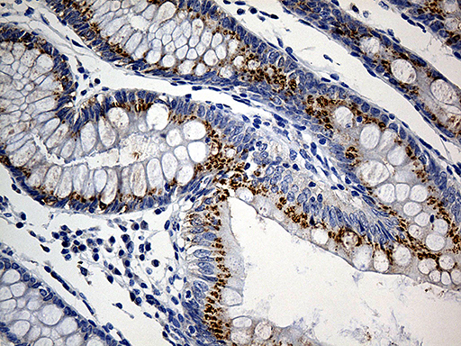 Immunohistochemical staining of paraffin-embedded Adenocarcinoma of Human colon tissue using anti-PRELID1 mouse monoclonal antibody. (Heat-induced epitope retrieval by 1mM EDTA in 10mM Tris buffer (pH8.5) at 120°C for 3min