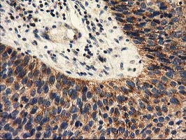 Immunohistochemical staining of paraffin-embedded Carcinoma of Human bladder tissue using anti-PYCR2 mouse monoclonal antibody