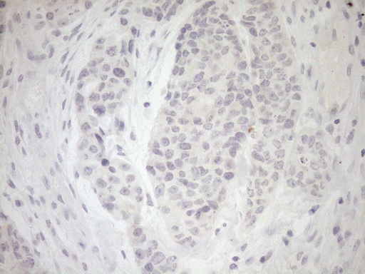 Immunohistochemical staining of paraffin-embedded Adenocarcinoma of Human endometrium tissue using anti-MYOZ1 mouse monoclonal antibody