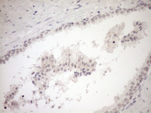 Immunohistochemical staining of paraffin-embedded Carcinoma of Human prostate tissue using anti-MYOZ1 mouse monoclonal antibody