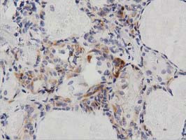 Immunohistochemical staining of paraffin-embedded Carcinoma of Human thyroid tissue using anti-PECR mouse monoclonal antibody