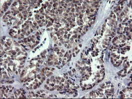 Immunohistochemical staining of paraffin-embedded Carcinoma of Human thyroid tissue using anti-RAB37 mouse monoclonal antibody