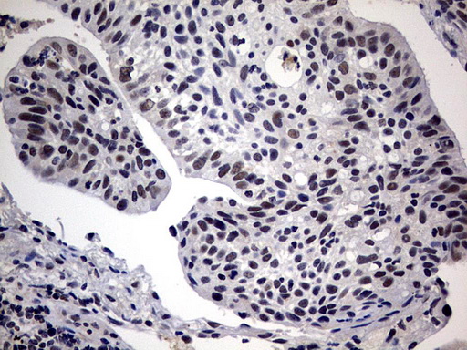Immunohistochemical staining of paraffin-embedded Carcinoma of Human lung tissue using anti-SAP30BP mouse monoclonal antibody. (Heat-induced epitope retrieval by 10mM citric buffer