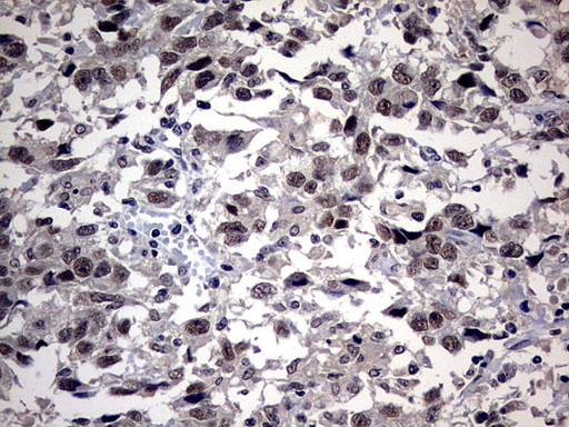 Immunohistochemical staining of paraffin-embedded Adenocarcinoma of Human ovary tissue using anti-SAP30BP mouse monoclonal antibody. (Heat-induced epitope retrieval by 10mM citric buffer