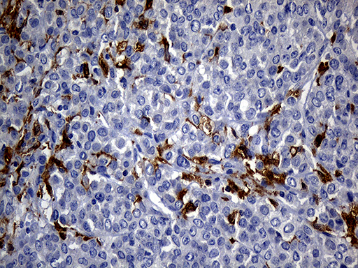 Immunohistochemical staining of paraffin-embedded Adenocarcinoma of Human breast tissue tissue using anti-UBE3B mouse monoclonal antibody