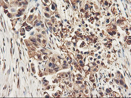 Immunohistochemical staining of paraffin-embedded Carcinoma of Human lung tissue using anti-RNPEP mouse monoclonal antibody. (Heat-induced epitope retrieval by 10mM citric buffer Immunohistochemical staining of paraffin-embedded Carcinoma of Human lung tissue using anti-RNPEP mouse monoclonal antibody. (Heat-induced epitope retrieval by 10mM citric buffer