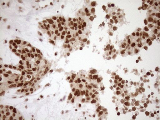 Immunohistochemical staining of paraffin-embedded Adenocarcinoma of Human endometrium tissue using anti-EXOSC1 mouse monoclonal antibody
