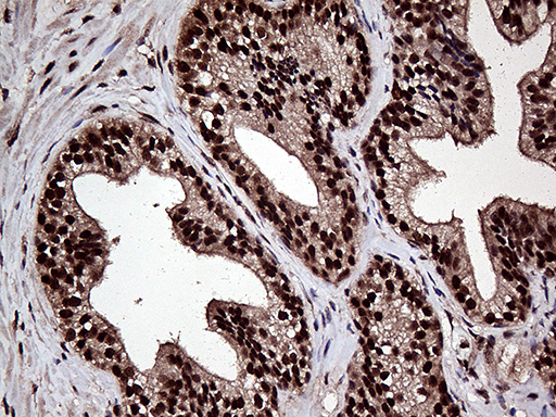 Immunohistochemical staining of paraffin-embedded Carcinoma of Human prostate tissue using anti-L3MBTL3 mouse monoclonal antibody